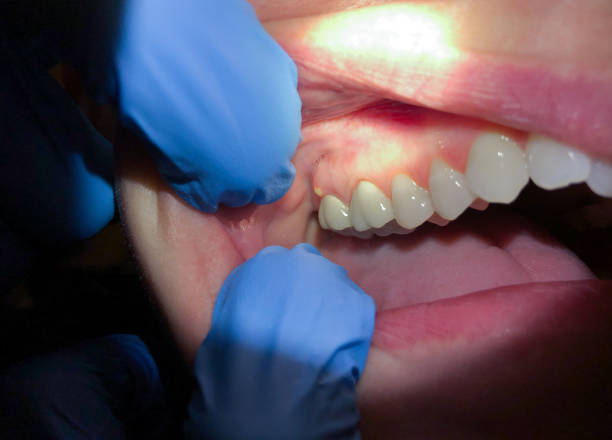Best Broken or Cracked Tooth Emergency Dentist in Boonville, NC